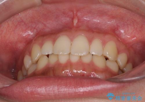 海外勤務中でも矯正治療 インビザラインによる軽度叢生改善の治療前