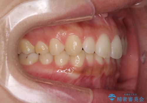 海外勤務中でも矯正治療 インビザラインによる軽度叢生改善の治療前