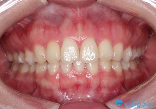 前歯のねじれをきれいにしたい　インビザラインによる見えない矯正治療の治療中