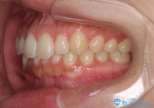 海外勤務中でも矯正治療 インビザラインによる軽度叢生改善の治療前