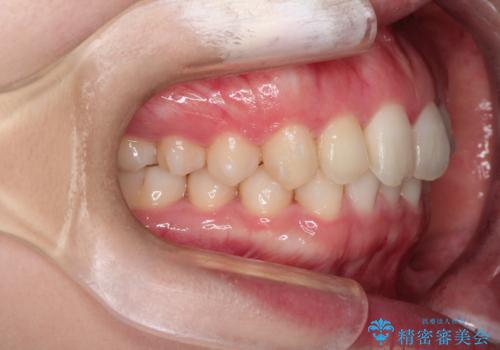 前歯のねじれをきれいにしたい　インビザラインによる見えない矯正治療の治療中