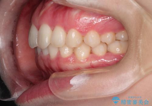 前歯のねじれをきれいにしたい インビザラインによる見えない矯正治療の治療中