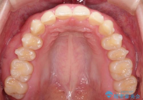 前歯のねじれをきれいにしたい　インビザラインによる見えない矯正治療の治療中