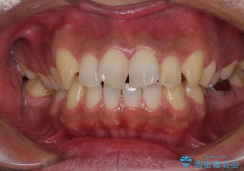 捻れた出っ歯の前歯 オールセラミッククラウンによる審美治療の治療前