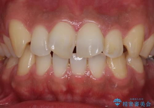 捻れた出っ歯の前歯　オールセラミッククラウンによる審美治療の治療前
