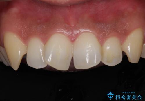 捻れた出っ歯の前歯　オールセラミッククラウンによる審美治療の症例 治療前