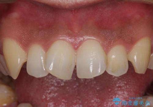 捻れた出っ歯の前歯 オールセラミッククラウンによる審美治療の治療前