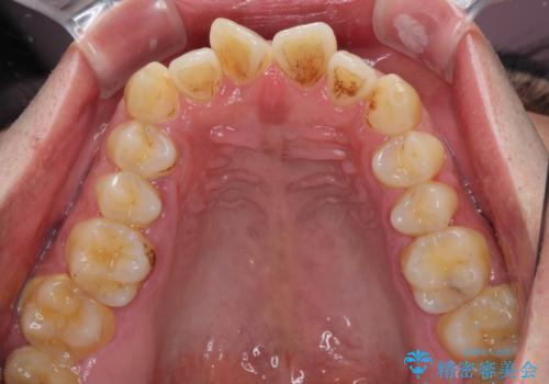 捻れた出っ歯の前歯 オールセラミッククラウンによる審美治療の治療前