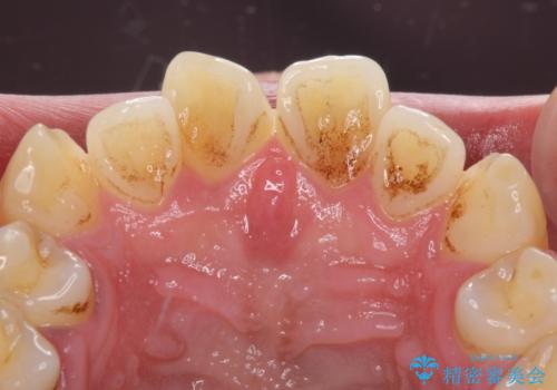 捻れた出っ歯の前歯　オールセラミッククラウンによる審美治療の治療前