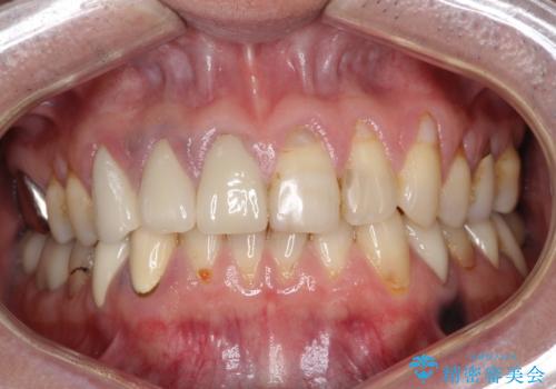 不自然な前歯のかぶせ物をオールセラミックへの症例 治療後