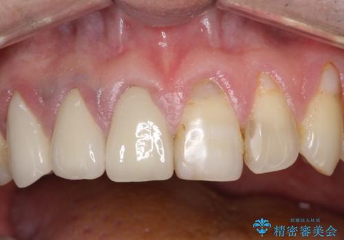 不自然な前歯のかぶせ物をオールセラミックへの治療後