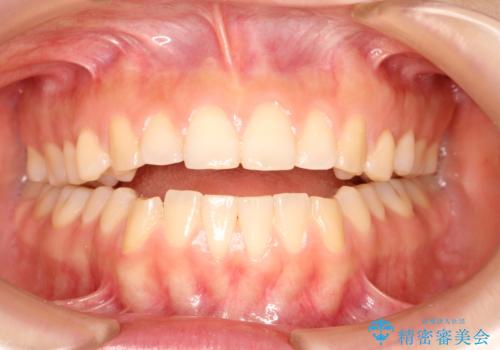 上下の前歯が当たらない インビザラインによる開咬の矯正治療の症例 治療前