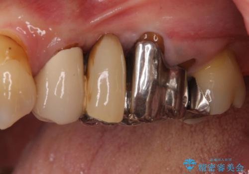 ものが挟まる 奥歯のセラミックブリッジ再製作の治療前