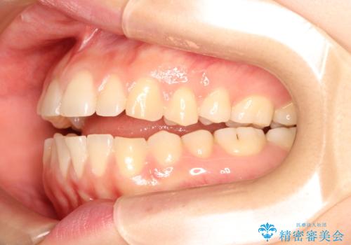 上下の前歯が当たらない インビザラインによる開咬の矯正治療の治療前