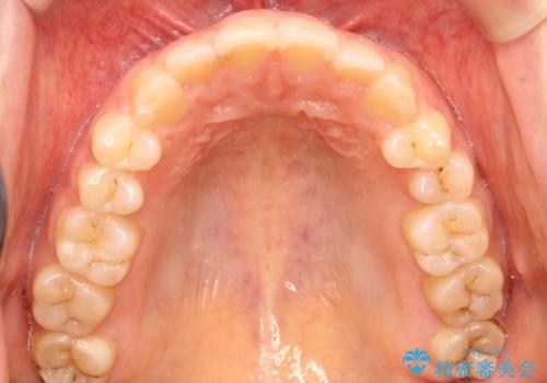 上下の前歯が当たらない　インビザラインによる開咬の矯正治療の治療前