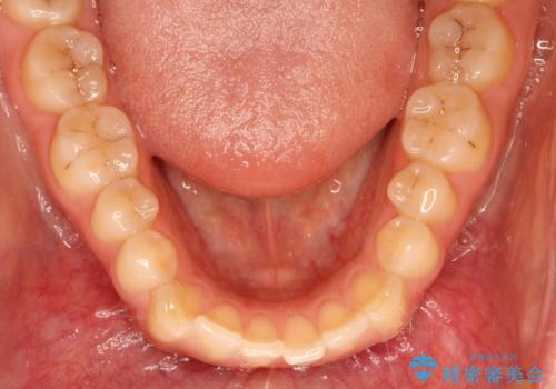 上下の前歯が当たらない インビザラインによる開咬の矯正治療の治療前