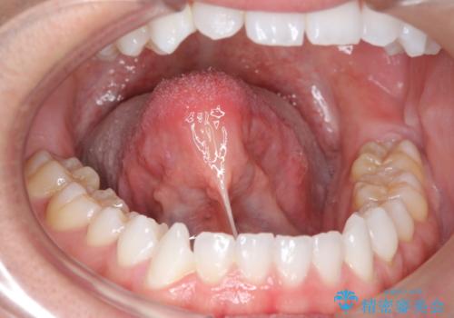 舌小帯を切りたい 発音を良くしたいの治療前
