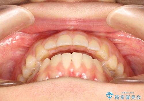 上下の前歯が当たらない　インビザラインによる開咬の矯正治療の治療前