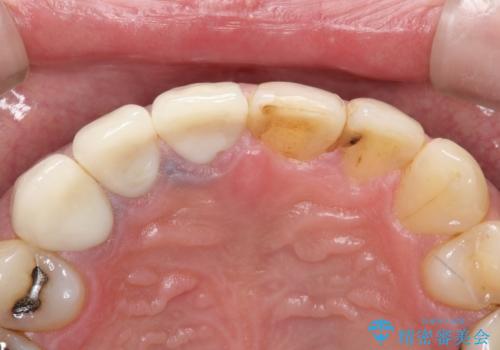 不自然な前歯のかぶせ物をオールセラミックへの治療後