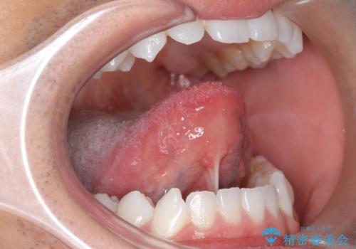 舌小帯を切りたい 発音を良くしたいの症例 治療前