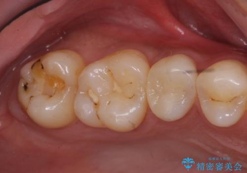 奥歯の虫歯 セラミックインレーにの治療前