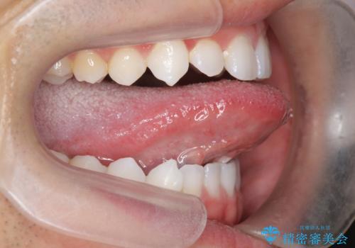 舌小帯を切りたい 発音を良くしたいの治療前