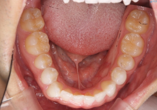 舌小帯を切りたい 発音を良くしたいの治療前