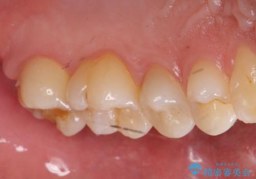 奥歯の虫歯 セラミックインレーにの治療前