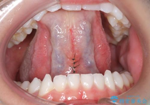 舌小帯を切りたい 発音を良くしたいの治療中