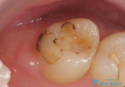 奥歯の虫歯 セラミックインレーに