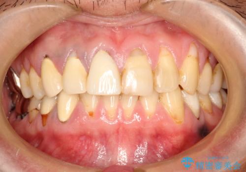 不自然な前歯のかぶせ物をオールセラミックへの症例 治療前