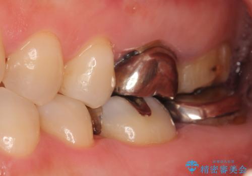 オールセラミッククラウン 歯茎より深い虫歯の治療 神経が死んでる歯の治療の治療前