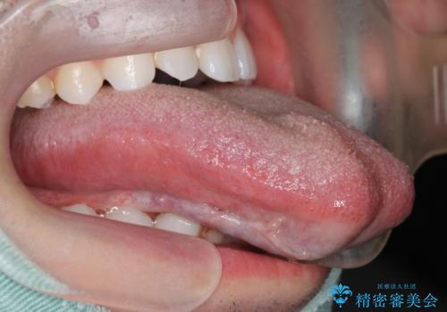 舌小帯を切りたい 発音を良くしたいの治療中