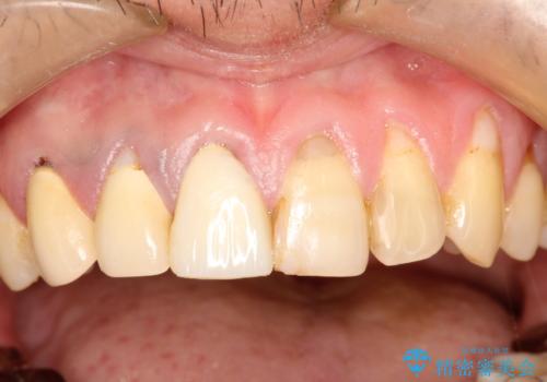 不自然な前歯のかぶせ物をオールセラミックへの治療前