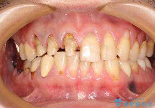 不自然な前歯のかぶせ物をオールセラミックへの治療中