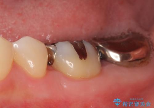 オールセラミッククラウン 歯茎より深い虫歯の治療 神経が死んでる歯の治療の治療前