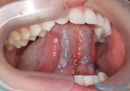 舌小帯を切りたい 発音を良くしたいの治療中