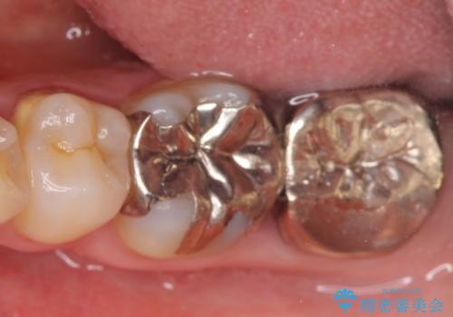 オールセラミッククラウン　歯茎より深い虫歯の治療　神経が死んでる歯の治療の症例 治療前