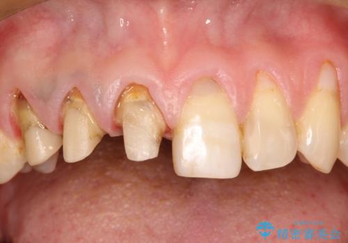不自然な前歯のかぶせ物をオールセラミックへの治療中