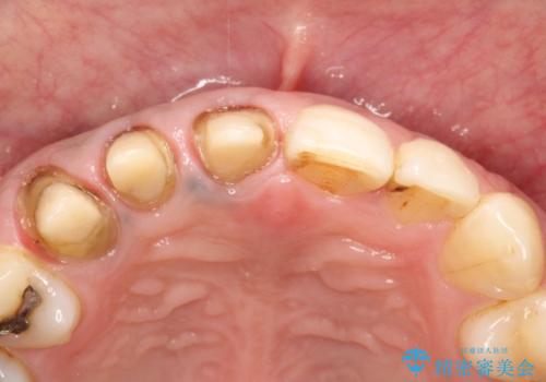 不自然な前歯のかぶせ物をオールセラミックへの治療中