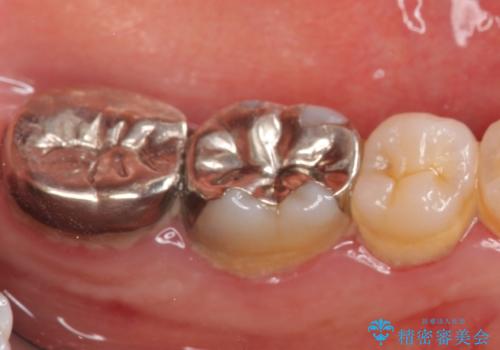 オールセラミッククラウン 歯茎より深い虫歯の治療 神経が死んでる歯の治療の治療前