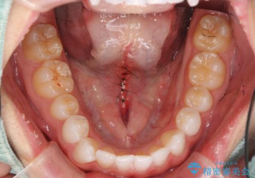 舌小帯を切りたい 発音を良くしたいの治療中