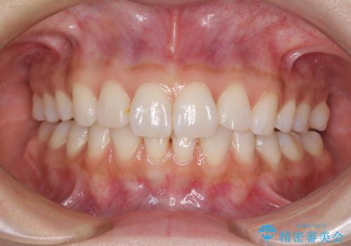 矯正治療の後戻り インビザラインによる再矯正治療の症例 治療後