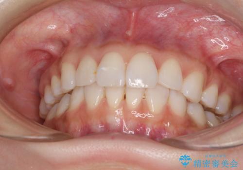 矯正治療の後戻り インビザラインによる再矯正治療の治療後