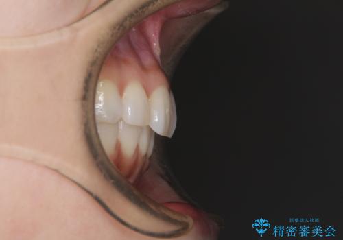 矯正治療の後戻り インビザラインによる再矯正治療の治療後