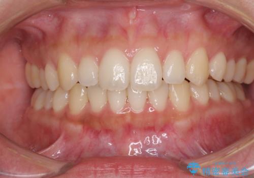 海外勤務中でも矯正治療 インビザラインによる軽度叢生改善の治療中