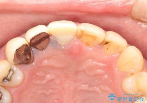 不自然な前歯のかぶせ物をオールセラミックへの治療前