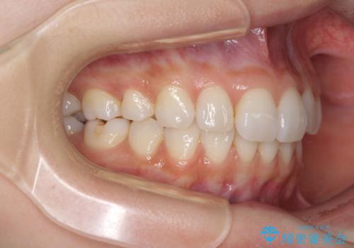 矯正治療の後戻り インビザラインによる再矯正治療の治療後