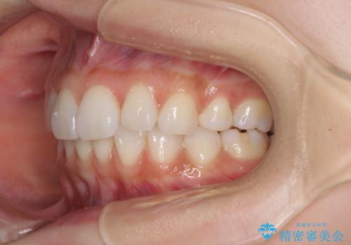 矯正治療の後戻り インビザラインによる再矯正治療の治療後