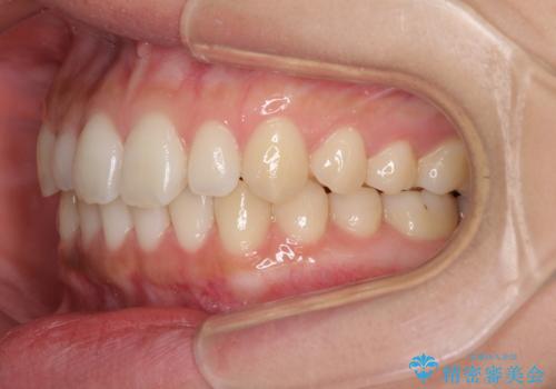 海外勤務中でも矯正治療 インビザラインによる軽度叢生改善の治療中